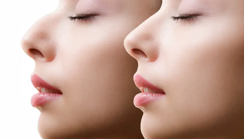 non-surgical rhinoplasty
