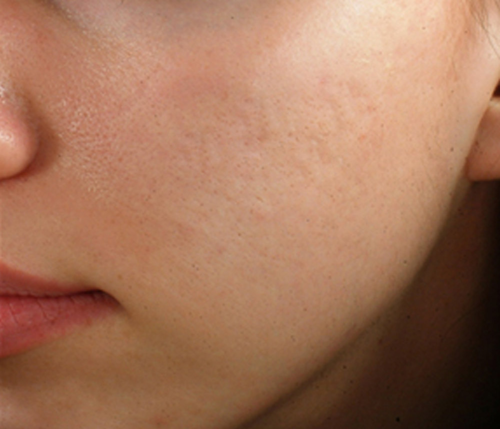 Microneedling after treatment at MiracleFace MedSpa Microneedling after treatment at MiracleFace MedSpa