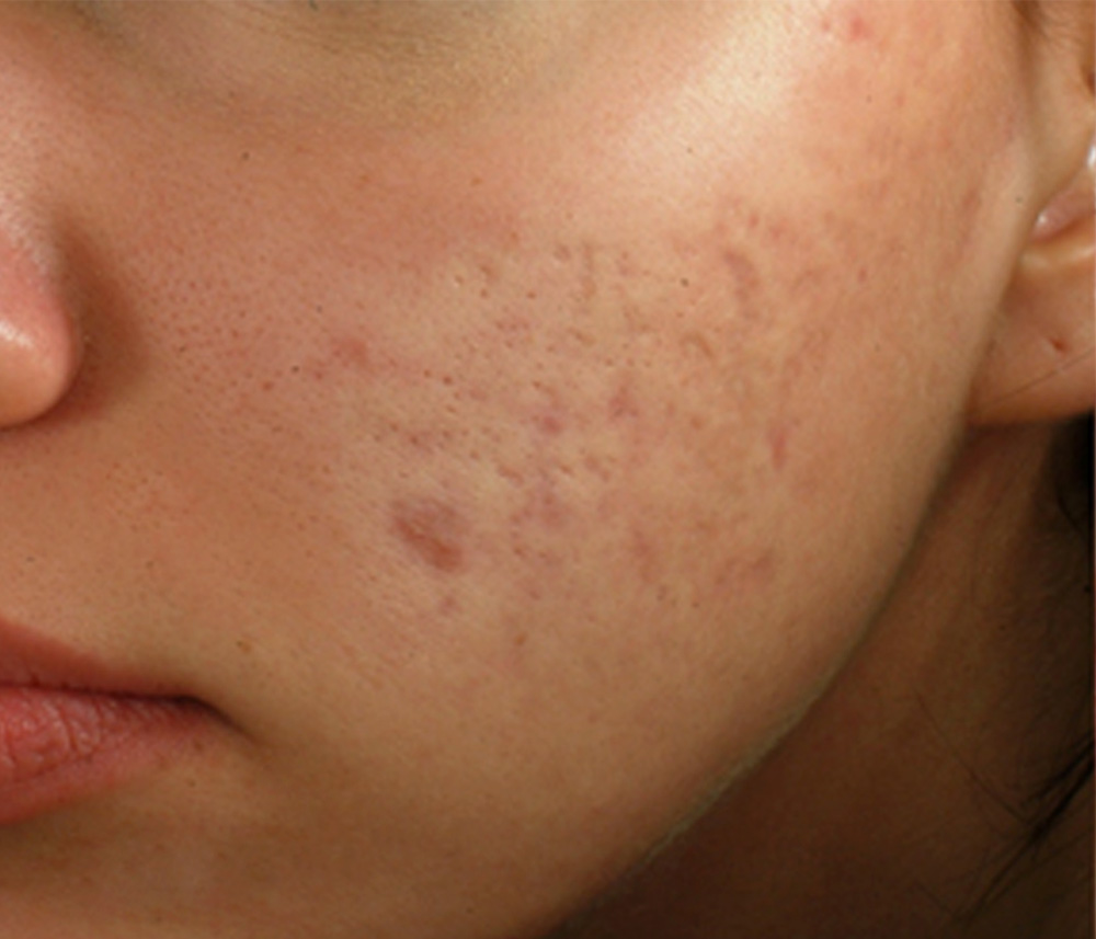 Microneedling before treatment Microneedling before treatment