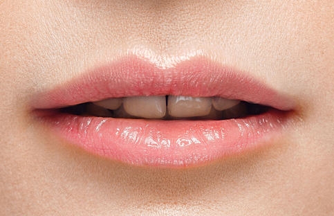 Lip Fillers Before Treatment Lip Fillers Before Treatment