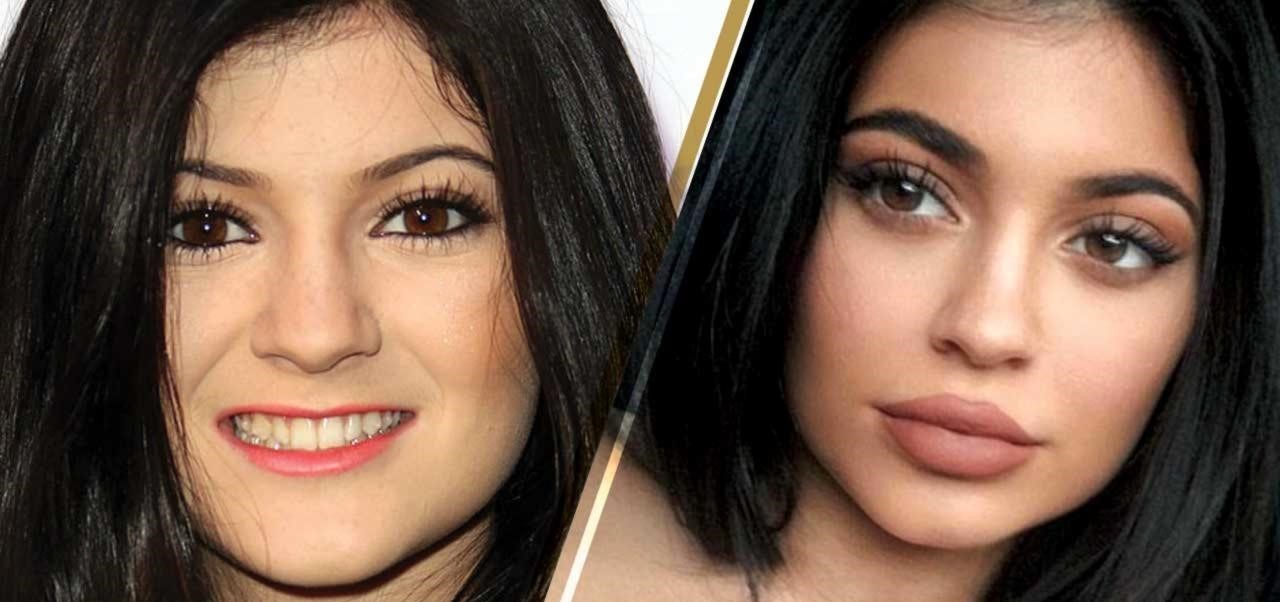 kylie jenner_before after
