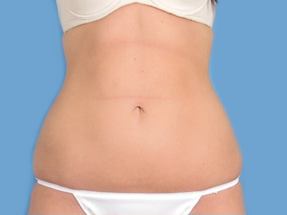 before coolsculpting before coolsculpting