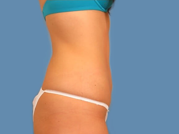 after coolsculpting profile image after coolsculpting profile image