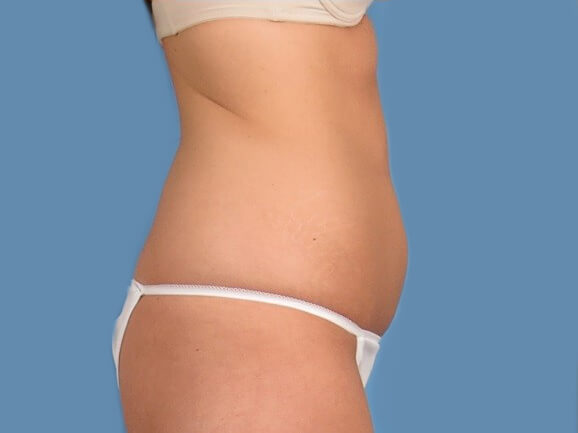 before coolsculpting profile image before coolsculpting profile image