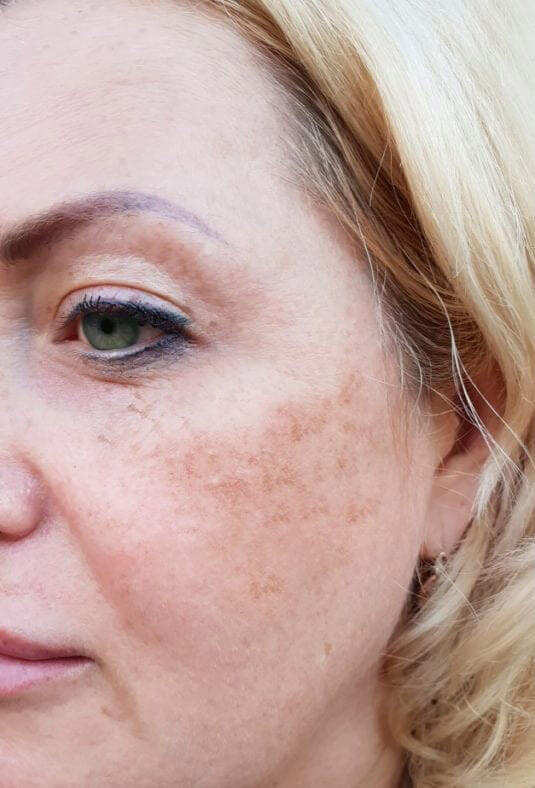 before fraxel laser treatment before fraxel laser treatment