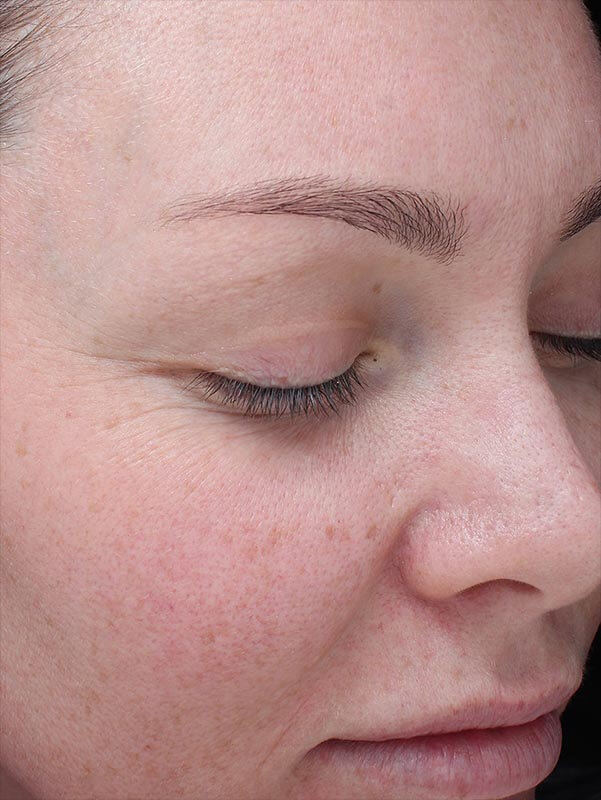 RF microneedling after RF microneedling after