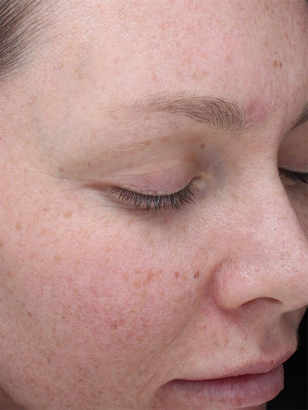 RF microneedling before RF microneedling before