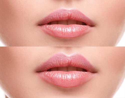 Lip Filler injections Before and after