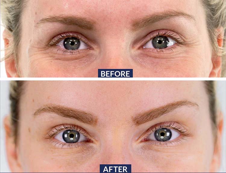 Botox for eye brow lift