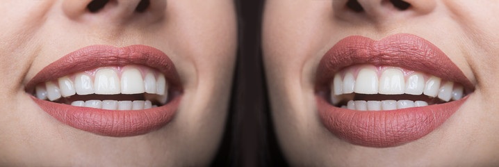 Botox lip flip before and after