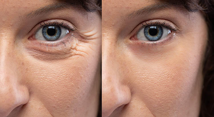 Botox under eyes before and after