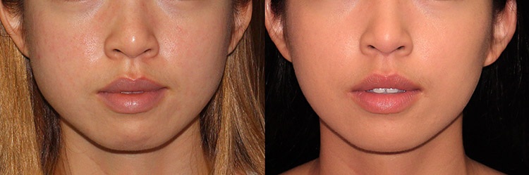 Chin and masseter Botox