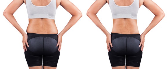 Coolsculpting back fat - before and after