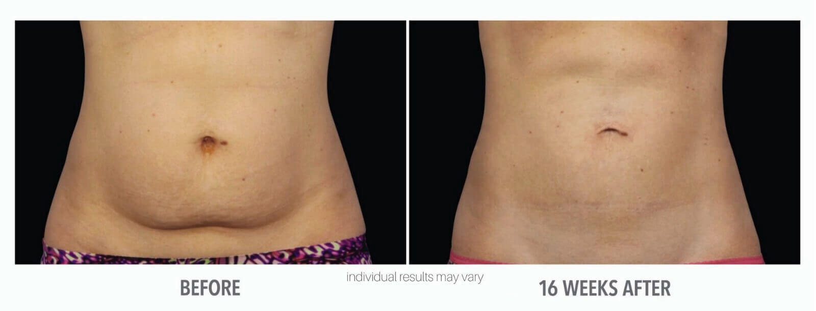 Coolsculpting Stomach before and after