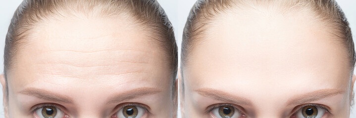 Botox forehead wrinkles before and after