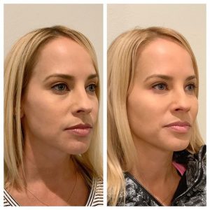 Cheek Filler before and after