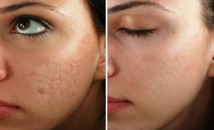 Microneedling session before after